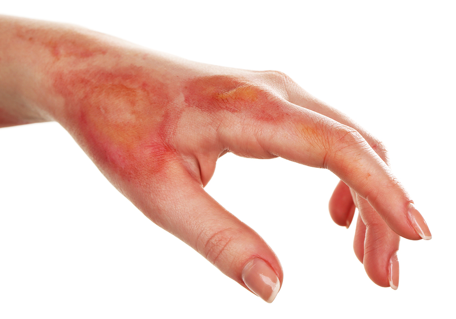 What are Burn Injuries usually caused by? Bruning Legal
