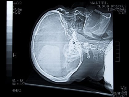 Contact the St. Louis head injury attorneys at the Bruning Law Firm today.