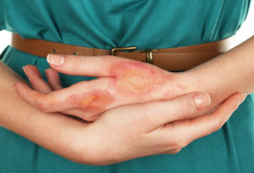 Burn Injuries can lead to a life of treatment and painful rehabilitation