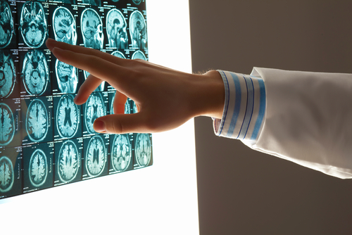 Contact the St. Louis traumatic brain injury attorneys at the Bruning Law Firm today.