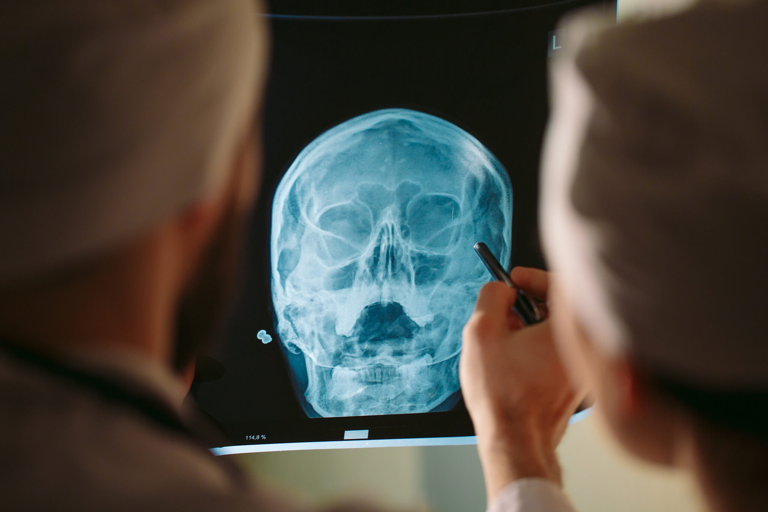 How Much Is a Head Injury Claim Worth?